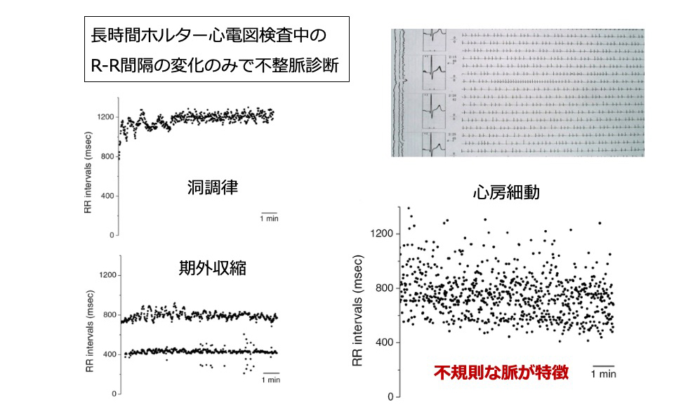不整脈重症度診断アプリのイメージ
