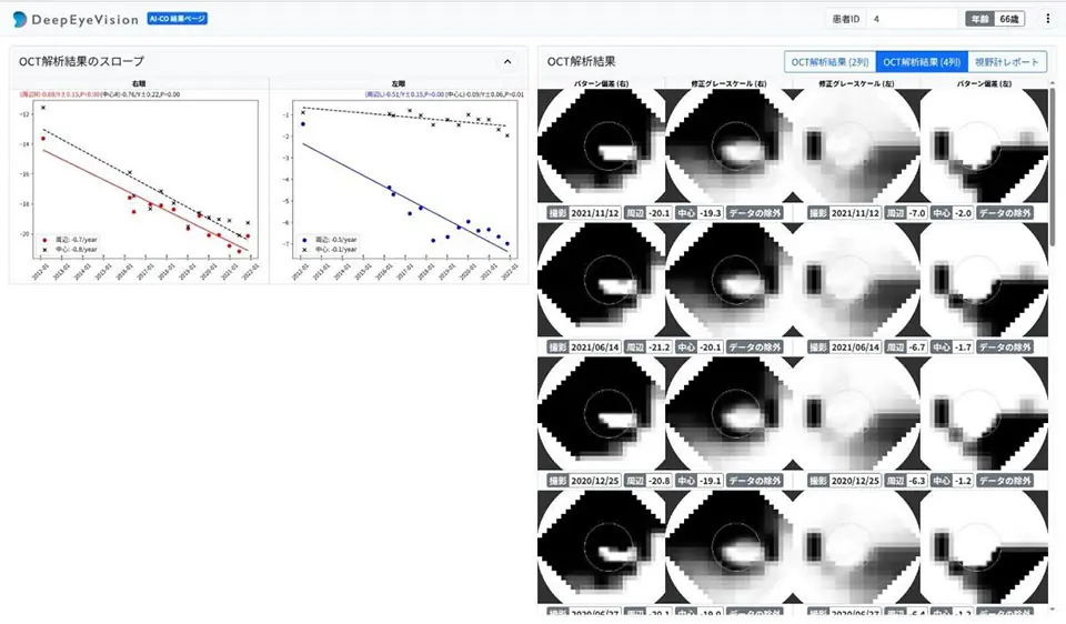 DeepEyeVision、緑内障診療支援プログラム「AI-CO」を販売開始
